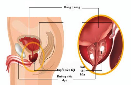 vôi tuyến tiền liệt